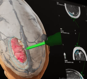 MRI Innovations in Neurosurgical Robotics and Navigation Systems