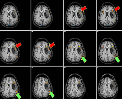 Advanced MRI Techniques in Neurosurgical Planning