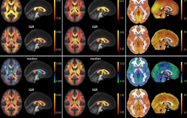 MRI in te Assessment of Traumatic Brain Injuries for Neurosurgeons