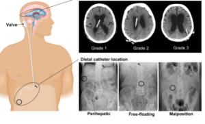 MRI in Hydrocephalus and Neurosurgical Shunt Placement