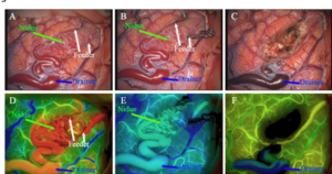 MR Angiography in Neurosurgical Management of Vascular Malformations