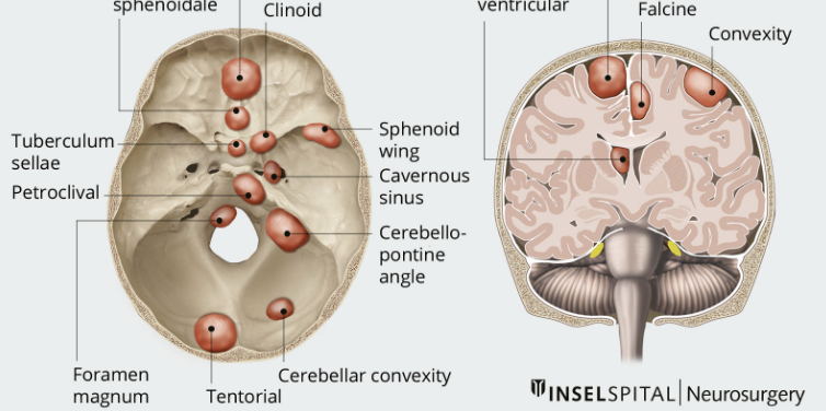 MRI and Brain Tumor Localization in Neurosurgery