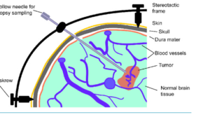 MRI and Image-Guided Neurosurgical Biopsies