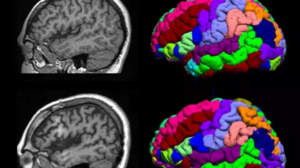 Quantitative MRI for Neurosurgical Risk Assessment