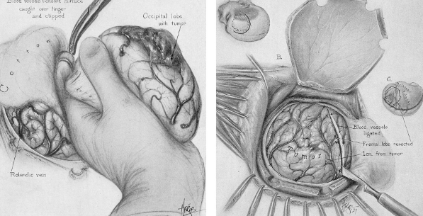 Neurosurgical Approaches in MRI for Glioma Management