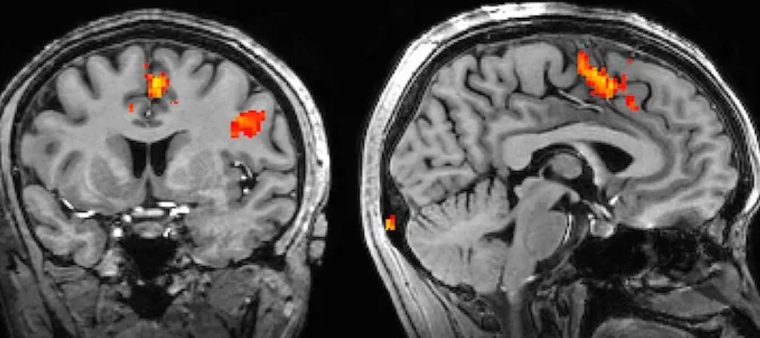 Functional MRI in Cognitive Neurosurgery