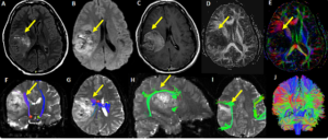 MRI Imaging in Neurosurgical Treatment of Brain Metastases