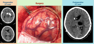 Neurosurgical Tumor Resection and MRI Imaging