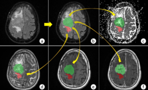 Advanced MRI Sequences in Neurosurgical Interventions