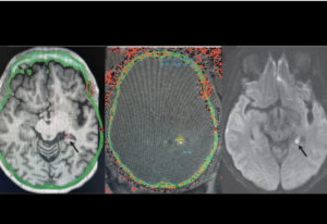 Real-Time MRI in Epilepsy Neurosurgery