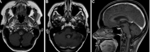 MRI-Guided Neurosurgical Interventions in Brainstem Lesions