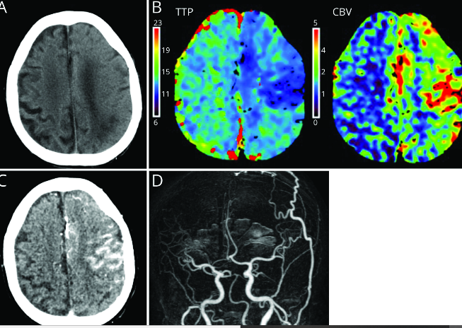 MRI Techniques in Neurosurgical Evaluation of Cerebral Edema