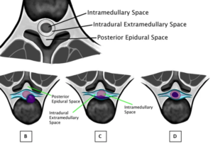 MRI in Neurosurgical Evaluation of Spinal Tumors