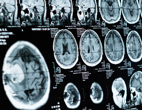 MRI in the Treatment of Traumatic Intracranial Hemorrhage