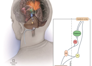 Neuroimaging and Neurosurgical Approaches to Stroke Recovery