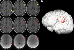 Functional MRI and Brain Mapping in Neurosurgical Decision-Making