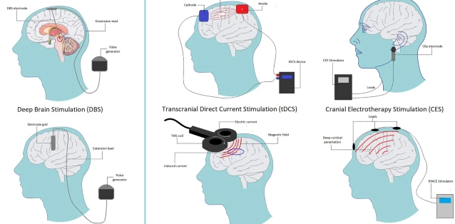 Using MRI to Assess Neurosurgical Interventions for Chronic Pain