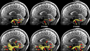 MRI for Neurosurgical Management of Trigeminal Neuralgia