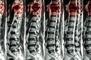 MRI for Spinal Cord Injury and Neurosurgical Treatment