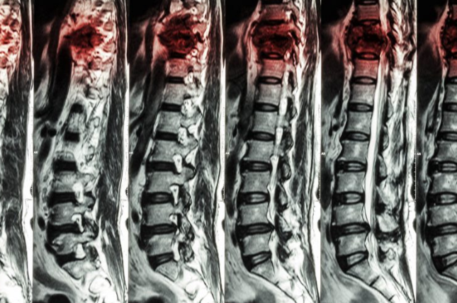 MRI for Spinal Cord Injury and Neurosurgical Treatment