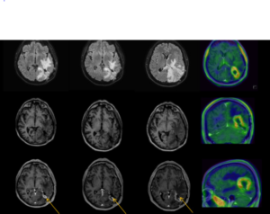 MRI-Based Radiomics in Neurosurgical Outcome Prediction