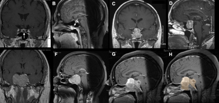 The Role of MRI in Neurosurgical Treatment of Pituitary Tumors