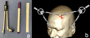 MRI-Guided Craniotomies: Precision Neurosurgery