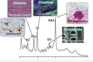 Magnetic Resonance Spectroscopy in Neurosurgical Oncology