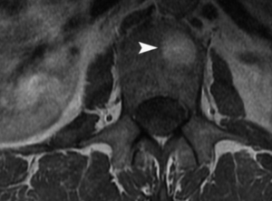 Understanding MRI Artifacts in Neurosurgery