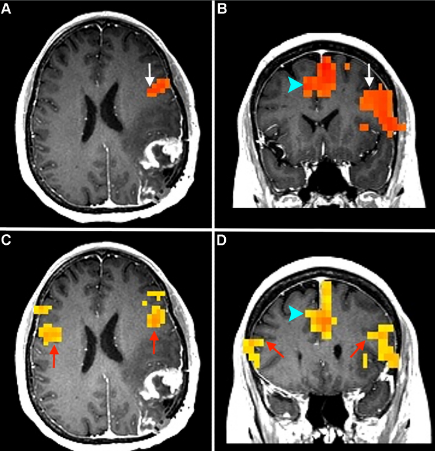 The Role of Functional MRI in Neurosurgery