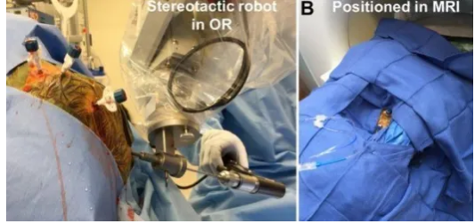 Integration of MRI and Robotics in Neurosurgical Procedures