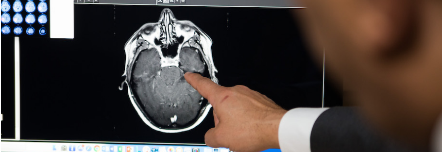 Functional MRI for Neurosurgical Planning in Brain Tumor Surgery