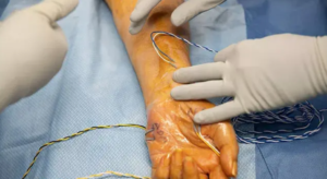 How Neurosurgery Can Help with Peripheral Nerve Disorders