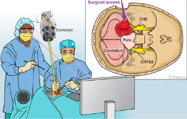 How Neurosurgery Is Tackling Brain Tumors with Precision