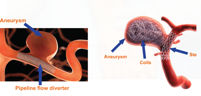 The Neurosurgical Approach to Treating Brain Aneurysms