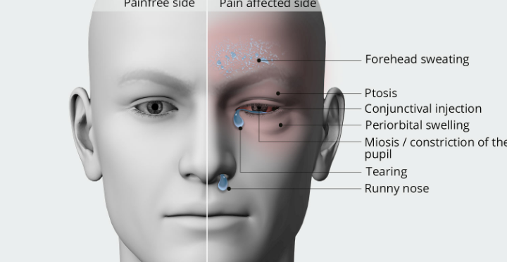 The Neurosurgical Approach to Treating Chronic Migraines